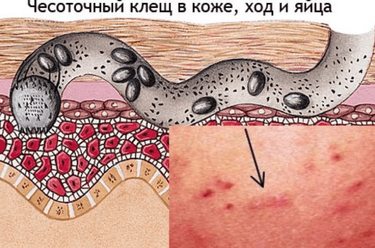 уничтожение чисотки